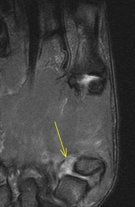 Figure 4 for case trapeziometacarpal dislocation